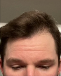 Frontal view of brunette man's hairline, after 2 months of Curology use.