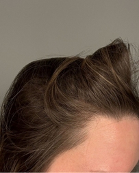 Brunette woman's hairline, after 3 months of Curology use.